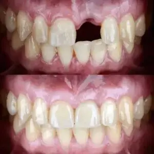 Before and after photo of a dental restoration