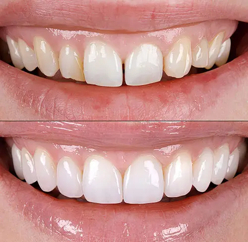 Smiling patient showing a smile makeover